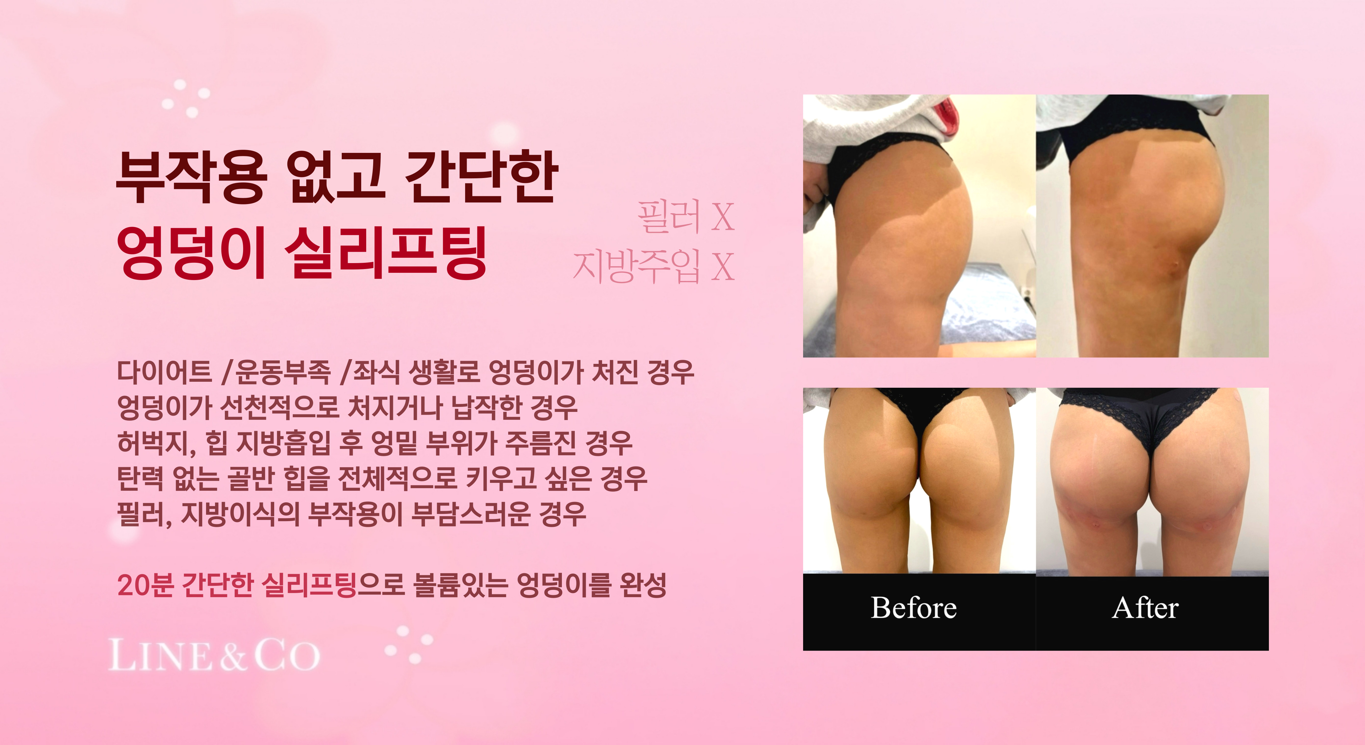 엉덩이 실리프팅